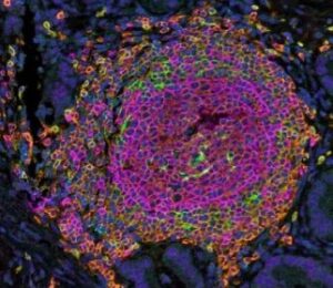 Tertiary Lymphoid Structure Tertiary Lymphoid Structure in Pancreatic Adeno Carcinoma (PDAC) Vanhersecke Nature Cancer 2021